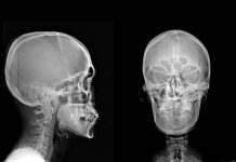 MESECIMA IMAO NESNOSNE GLAVOBOLJE, POČEO JE DA GUBI VID: Lekari se šokirali kad su pronašli uzrok “Otkud ovo ovde?!”