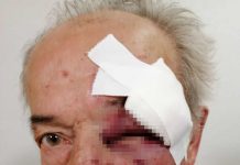 SAZNAJEMO! U BEOGRADU PRETUČEN GENERAL U PENZIJI: Trojica ga pesničila na autobuskoj stanici, zatvorili mu oko! (UZNEMIRUJUĆ FOTO)