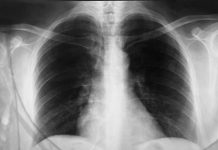 SVI SE ŽALE NA JAK KAŠALJ P0SLEDNJIH MJESEC DANA: Pulmolog dao DIJAGNOZU, ovo ni malo NIJE NAIVNO