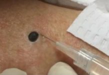 ŽENA JE GAJILA OVO NA LEĐIMA: Kada je doktorka uzela špric i bocnula, shvatit ćete zašto je SNIMAK pregledalo 33 miliona ljudi!