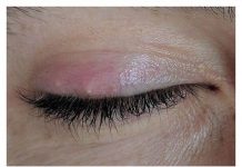 KAKO IZLIJEČITI ČMIČAK NA OKU: Ovu su prirodna rješenja za ovu neprijatnu izraslinu na oku