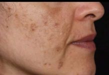 Ova smjesa briše tamne mrlje kao gumicom, zapišite recept