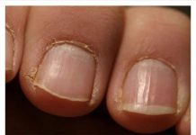 IMATE LI OVAKVE IZBOČINE NA NOKTIMA – Evo šta one znače: Doktorica otkrila, obratite pažnju