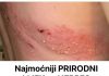 Najmoćniji PRIRODNI LIJEK za HERPES ZOSTER: uklonite ga zauvijek!