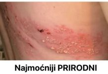 Najmoćniji PRIRODNI LIJEK za HERPES ZOSTER: uklonite ga zauvijek!