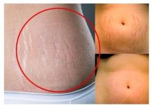 UKLONITE CELULIT i STRIJE UZ SAMO 2 SASTOJKA: Smjesu umasirajte na problematični dio i sačekajte 20 min