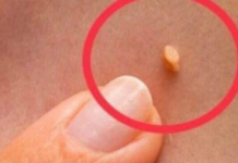 BILJKA KOJA SPALJUJE BRADAVICE KAO LASEROM: A samo ako je ovako koristite