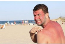 ZBOG JEDNE GREŠKE BOLI I NASTAJU PLIKOVI: Ako izgorite na suncu, dva sastojka su spas, ali samo ako ih ovako mažete