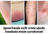 Ignoriranje ovih vrsta ujeda insekata može uzrokovati nepovratne komplikacije: Ako primijetite ove simptome, ODMAH POZOVITE LJEKARA