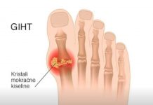 Evo tri narodna lijeka za giht kojima je cilj eliminirati mokraćnu kiselinu iz tijela, što predstavlja potencijalno rješenje za one koji traže olakšanje.