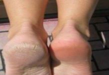 Zaboravite na ispucale pete, kurje oko i gljivice na nogama: Jeftina namirnica je pravi spas