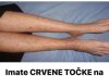 Imate CRVENE TOČKE na nogama? Žene trebaju obratiti pozornost jer se to lako može sprječiti