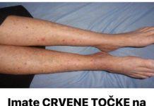 Imate CRVENE TOČKE na nogama? Žene trebaju obratiti pozornost jer se to lako može sprječiti