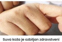 Suva koža je ozbiljan zdravstveni simptom koji mnogi ljudi ignoriraju: OVAJ BOLESNI ORGAN VAPI ZA POMOĆ!