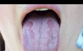 ZAUVIJEK SE RIJEŠITE KANDIDE: Ovaj recept se rješava ove opasne gljivice!