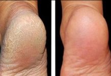 Za meka stopala potrebna su vam samo 3 kuhinjska sastojka: