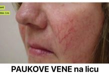 Prisutnost paučastih vena na licu služi kao ključni pokazatelj, signalizirajući mogućnost nadolazeće bolesti.