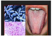 KANDIDA UNIŠTAVA ORGANIZAM I IMUNITET: Napravite ovaj napitak I ZAUVIJEK JE SE RIJEŠITE (RECEPT)