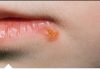 Da li vam je imunitet oslabljen i na usnama se pojavi herpes? Riješite se toga na prirodan način!