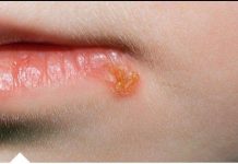 Da li vam je imunitet oslabljen i na usnama se pojavi herpes? Riješite se toga na prirodan način!