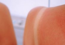 NAJBRŽI NAČIN DA IZLEČITE OPEKOTINE OD SUNCA ZA 30 MINUTA: Genijalan trik za koji mnogi nisu znali da pomaže