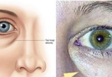SVE STE PROBALI, ALI SU PODOČNJACI I DALJE TU? Probajte masku od SODE BIKARBONE, CRNOG ČAJA, ili ovih namirnica!