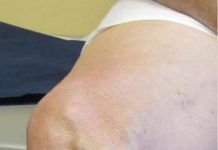 ČUDOTV0RNI MELEM: Pomiješajte 0va Tri SAST0JKA I Proširene Vene Će Nestati PREK0 N0ĆI