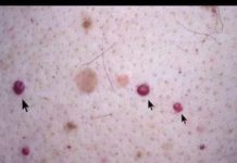 IMATE LI OVE CRVENE TAČKICE NA TIJELU? To nisu popucali kapilari, EVO O ČEMU SE ZAISTA RADI