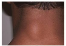 Ukoliko imate masno tkivo na koži, pročitajte tekst kako bi nestao prirodnim putem