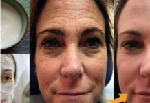 Ovako sam se riješila BORA tako što sam prala lice sa ovom snažnom smjesom od 2 sastojka!