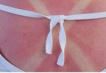 IZGORILI STE NA SUNCU I KOŽA VAM SE LJUŠTI? Probajte ovaj SUPER TRIK, zaboravite na jogurt – OVO ĆE VAS SPASITI