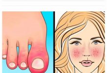 10 Znakova AUTOIMUNIH BOLESTI kod kojih tijelo samo sebe uništava