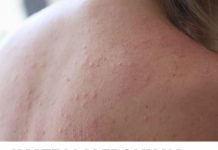 IMATE LI ALERGIJU NA SUNCE: Evo koji su simptomi i kako ih prirodno eliminirati