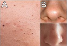 MITISERI SAMI ISPADAJU IZ PORA, ŽENA POKAZALA GENIJALAN TRIK: Uradite ove 3 stvari i oduševit ćete se licem