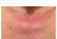 Zašto me tijelo svrbi nakon tuširanja? Ako i vi imate crvene mrlje, evo zašto