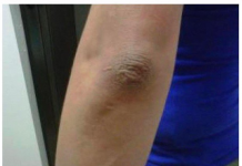 OVA PROMJENA NA LAKTU GOVORI DA SA VAŠIM ORGANIZMOM NEŠTO NIJE U REDU: Evo o kakvoj bolesti se radi