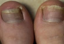 Ovako možete jednostavno liječiti urasli nokat u 2 minute: Ovaj bezbolni postupak štedi vam posjet liječniku. SVAKO TO MOŽE