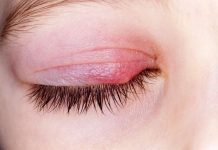 KAKO IZLIJEČITI ČMIČAK NA OKU: Ovu su prirodna rješenja za ovu neprijatnu izraslinu na oku