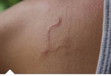 MISLIO JE DA JE PROŠIRENA VENA: Nakon mjesec bolova, saznao je da U NJEGOVOM TIJELU ŽIVI OVO!