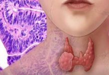 AKO IMATE PROBLEM SA ŠTITNOM ŽLIJEZDOM, OVE 2 NAMIRNICE IZBACITE: Štitna žlijezda ih nikako ne voli