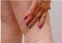 Namažite noge ovim uljem i više nikad nećete imati problema sa proširenim venama! (RECEPT)