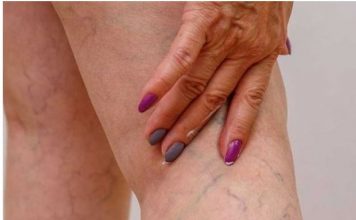 Namažite noge ovim uljem i više nikad nećete imati problema sa proširenim venama! (RECEPT)