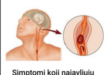 Simptomi moždanog udara kod žena