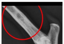 PRVI SIMPTOM KARCINOMA KOSTIJU: Evo koji znak ukazuje na smrtonosnu bolest