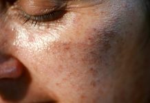 MAZALA JE LICE SA OVIM, STARAČKE PJEGE SU NESTALE: Ovako se zauvijek riješite SMEĐIH MRLJA sa kože, savjetuje poznati dermatolog