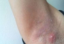 LJUDI SE NE PERU ISPOD PAZUHA KAKO TREBA: Stručnjak za higijenu savetuje čime da izlečite bubuljice i uklonite znoj