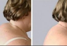 STVORILA VAM SE GRBA NA VRATU? EVO KAKO ĆETE JE ISPRAVITI: Trebate samo slediti ovih 5 saveta!