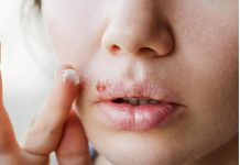 KAD IZAĐE, SVI KAŽU: “PAO TI JE IMUNITET”! Evo zbog čega nastaje HERPES i koliko dugo traje – postoje DVIJE vrste LIJEČENJA