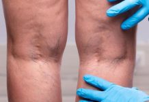 BOL U NOGAMA MOŽE BITI UPOZOERENJE ZA TIHOG UBICU: Teška bolest koja od koje leti strada najviše osoba