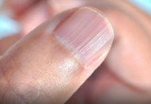 IMATE LI OVAKVE IZBOČINE NA NOKTIMA – evo šta one znače: Doktorica otkrila i možda ćete se iznenaditi